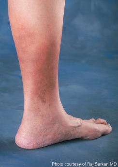 Can Cialis Cause Leg Swelling